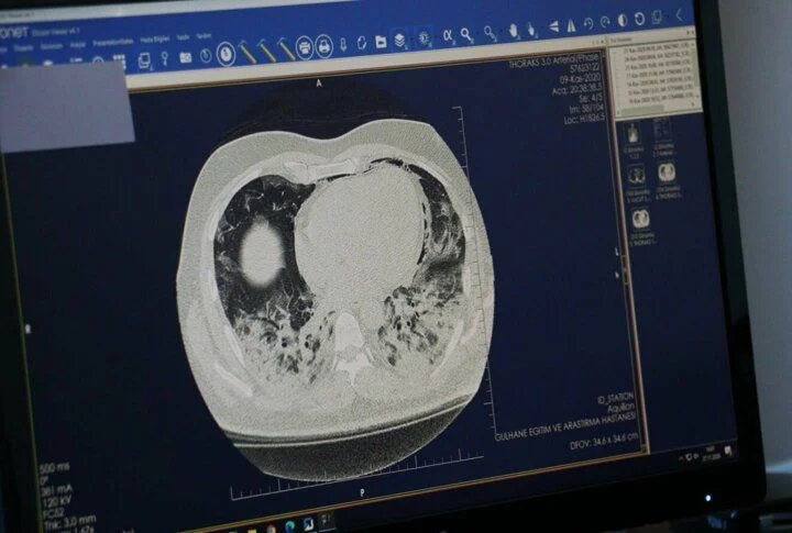 Doç. Dr. Taşçı: Kovid-19 akciğerdeki solunum keseciklerinde hasara yol açıyor