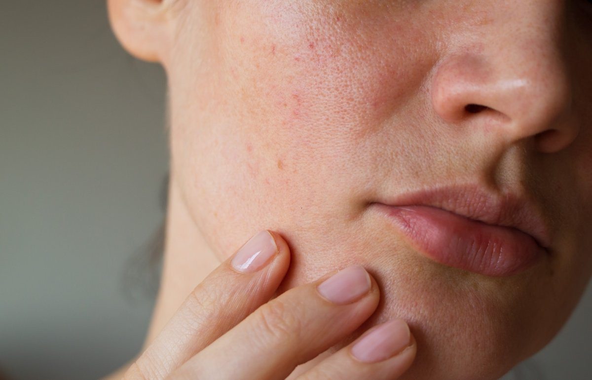 Dudak kuruluğu neden olur? Çatlak dudaklar ve kuru ciltler için önemli ipuçları