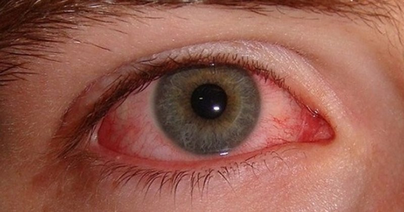 Göz kanlanması nasıl geçer? - Sağlık Haberleri